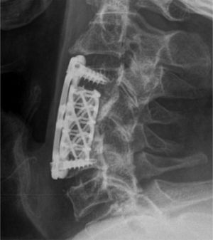 Radiografía de columna cervical de control posquirúrgico.