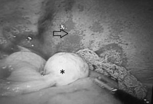 Laparotomía exploradora que muestra ovario izquierdo de características normales (*), sin características macroscópicas de tumor, asas intestinales edematosas y peritoneo con fragilidad capilar (flecha).