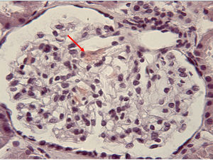 Imagen de la tinción rojo Congo (×40) del glomérulo del paciente, mostrando positividad para el amiloide depositado en el mesangio (flecha).