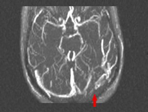 Angio-RM venosa 2D-TOF transversal; trombosis venosa en el seno transverso izquierdo con ligera prolongación al seno sigmoideo izquierdo.