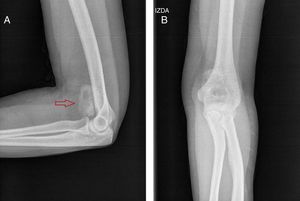 Radiografía simple de codo izquierdo en proyección lateral (A) y anteroposterior (B).