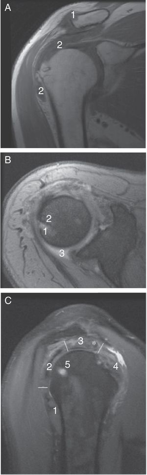A) Imagen por RM de hombro derecho en adquisición coronal en secuencia potenciada en T1. En una imagen superponible a la radiografía de la figura 1 B se observan los tofos como masas de tejidos blandos hipointensas en T1 en el borde superior del extremo clavicular distal (1) y en la bursa subacromiodeltoidea (2). B) Imagen en adquisición axial T2 eco de gradiente. La RM revela una lesión compatible con tofo gotoso (1) en el borde articular glenohumeral no claramente visible en la radiografía simple. Es hiperintenso en secuencia potenciada en T2, interrumpe la corteza ósea y tiene un reborde muy hipointenso por la esclerosis ósea (2). Se asocia un discreto derrame synovial (3). C) Imagen en adquisición sagital en densidad protónica que permite ver la sección de los tendones que forman en manguito de los rotadores: redondo menor (1), infraespinoso (2), supraespinoso (3) y subescapular (4). El supraespinoso está especialmente desestructurado por la presencia de un nódulo sugestivo de tofo intratendinoso (*). Como en la secuencia potenciada en T2, el tofo óseo es hiperintenso (5).
