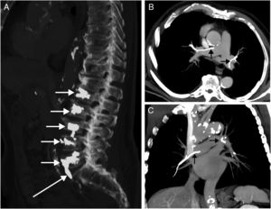 A) Imagen sagital de la TC en la que se observa material de cementación en los cuerpos de las 5 vértebras lumbares (flechas cortas). Nótese la presencia de una fuga de cemento desde el cuerpo de la quinta vértebra lumbar hacia la vena ilíaca común derecha (flecha larga); esta fuga probablemente sea la responsable de la embolia de cemento a las arterias pulmonares. B y C) Imágenes axial (B) y coronal (C) de la TC (proyección de máxima intensidad) en las que se visualizan múltiples defectos de repleción lineales de muy alta densidad (flechas) en la luz de las arterias pulmonares principales que representan embolias de material de cementación.