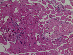 Biopsia de músculo que muestra infiltrado linfocitario endomisial y necrosis de miocitos.