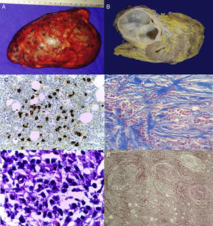 A) Tumor macroscópico. B) Pieza quirúrgica, lesión sólida bien delimitada de aspecto fibroso que no invade el parénquima renal. C) Microfotografía (40x). Reacción de inmunoperoxidasa indirecta con anticuerpo anti-IgG4, con más de 40 células plasmáticas. D) Microfotografía (40x) con tinción de Masón. Fibrosis con patrón focalmente esteriforme. E) Microfotografía (100x). Infiltrado inflamatorio compuesto predominantemente por células plasmáticas. F) Microfotografía (10x). Flebitis obliterante en relación con fibrosis extensa e infiltrado linfoplasmocitario.