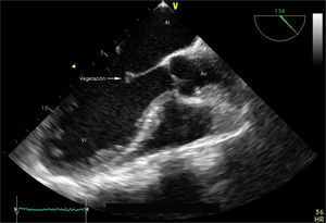 Vegetación de 4×5mm en el festón A2 de la valva anterior de la válvula mitral con insuficiencia.