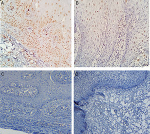 Perfil inmunohistoquímico apoptótico de mucosa oral en pacientes con osteonecrosis inducida por BF. A) Microfotografía 40x que muestra expresión nuclear Bax en epitelio, principalmente en capa basal y parabasal. B) Microfotografía 40x que muestra expresión nuclear Bax en estrato espinoso del epitelio. C y D) Ausencia de expresión de Bcl-2 C) y survivina D) en epitelio de mucosa oral.