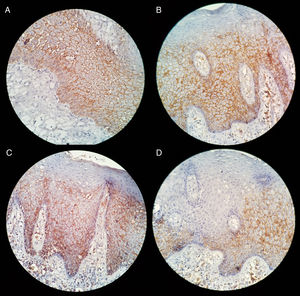 Expresión de syndecan-1 en epitelio de mucosa oral contigua a osteonecrosis inducida por BF. A) Expresión en membrana citoplasmática. B y C) Se observa pérdida de la expresión en la zona superficial del epitelio. D) Pérdida de expresión de syndecan-1 en áreas completas del epitelio.