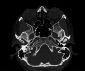 TAC en la que se aprecian deformidad condilar con osteoesclerosis, aplanamiento y osteofitos.
