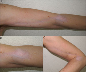 A-C) Placa atrófica hipopigmentada en codo con extensión lineal a lo largo del brazo.