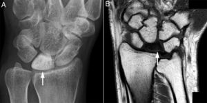 Radiografía simple del carpo izquierdo correspondiente al caso 3 que muestra marcada esclerosis del hueso semilunar (A, flecha). RM del carpo derecho (secuencia T1) correspondiente al caso 2, en la que se evidencia señal hipointensa en el hueso semilunar (B, flecha).