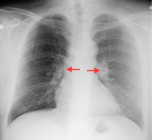 Chest graph showed bilateral hilar enlargement.