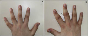 A,B) Deformidad y tumefacción en la cara lateral de IFP de los dedos segundo, tercero y cuarto, con predominio en la mano derecha (flechas).
