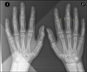 Imagen radiográfica con aumento de partes blandas en la segunda, tercera y cuarta IFP en la mano derecha, sin datos de afectación articular u ósea asociados (flechas).