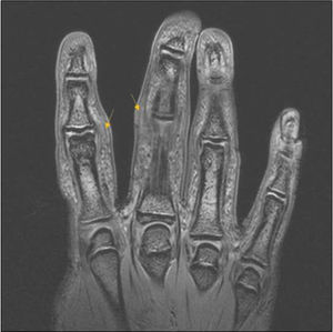 Imagen de la RM de la mano derecha, donde se observa un aumento de partes blandas con alteración de señal por edema del segundo, tercer y cuarto dedos (flechas).