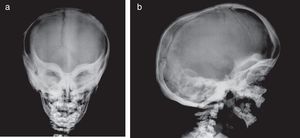 Radiografía simple de cráneo en proyección anteroposterior (a) y lateral (b). Esclerosis de órbitas y alas del esfenoides, confiriendo un aspecto de «máscara de arlequín». Engrosamiento del diploe y aumento de densidad difuso en la calota y la base del cráneo.