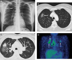 A) Radiografía de tórax en la que se observa una opacidad nodular en LSD (flechas). B) Imagen axial de la primera TC de tórax (ventana de parénquima pulmonar) en la que se confirma una lesión nodular de atenuación ground-glass (flecha). C) Imagen axial MIP (proyección de intensidad máxima) de la segunda TC de tórax (ventana de parénquima pulmonar) en la que se observa una progresión radiológica a pesar del tratamiento antituberculoso y el signo de la «galaxia»: opacidades nodulares sólidas (flechas) rodeadas de numerosos nódulos sólidos de 1-2mm. D) Imagen coronal de SPECT/TC con galio en la que se identifica captación por parte de los nódulos pulmonares (flechas blancas) y de las adenopatías del hilio pulmonar derecho y del mediastino ipsolateral (flechas negras).