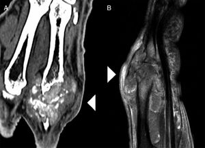 Imagen de TC (A) y de RM (B). La lesión tiene una morfología lobulada, componente heterogéneo con zonas calcificadas en su interior y produce destrucción de superficies óseas de la articulación metacarpofalángica (cabezas de flecha blanca).