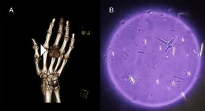 A) Se observa la reconstrucción en volumen rendering, que revela una tumoración de partes blandas en la articulación metacarpofalángica. B) Estudio con microscopio óptico que detectó cristales de urato monosódico con forma de aguja en el interior de la tumoración.