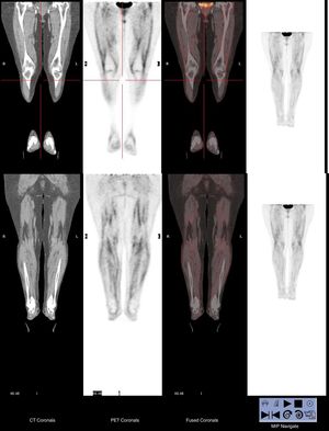FDG-PET/CT revealed a diffuse and symmetrical FDG uptake in the fasciae of the lower limbs, clearly illustrating the anatomical involvement of the disease.
