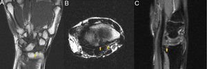 Imágenes de RMN potenciadas en T1 (A: plano coronal, B: plano axial) y de densidad protónica con supresión de la grasa en el plano sagital (C). Se aprecian dos erosiones en la cara articular distal del radio (flechas) sin claro edema medular en el hueso subyacente.