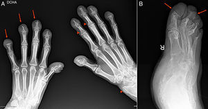 A) Radiografía anteroposterior de ambas manos. Aumento de partes blandas a nivel de falanges distales. Marcados cambios destructivos con acro-osteólisis en todas las falanges distales (flechas), con formación de superficies planas en quinta falange bilateral, proliferación ósea a nivel de radio izquierdo y más discreta en base de varias falanges distales (puntas de flecha). B) Radiografía oblicua del pie derecho. Reabsorción de falanges distales de todos los dedos con formación de superficies planas (flechas).