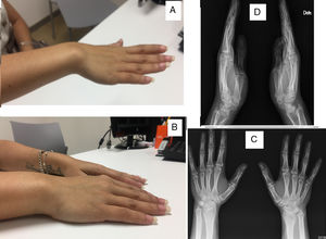 A y B) Dislocación dorsal del cúbito. C) Radiografía posteroanterior de manos bilateral. D) Radiografía lateral de manos bilateral.