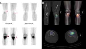 Gammagrafía en 2 fases (A) que muestra una intensa hipercaptación del radiotrazador en tercios proximales de las tibias. Las imágenes híbridas de SPECT/TC y reconstrucción 3D (B) muestran actividad osteoblástica en epífisis de ambas tibias sin afectación de partes blandas adyacentes.