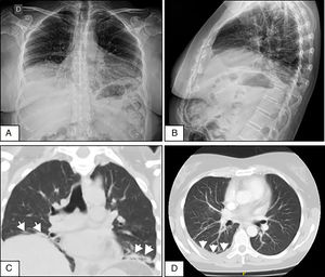 A y B. Radiografías de tórax de frente y perfil que evidencian elevación de ambos hemidiafragmas y atelectasias laminares bibasales. C. Corte coronal de tomografía de tórax sin contraste que demuestra elevación diafragmática y atelectasias subsegmentarias (flechas) en ambas bases pulmonares. D. Tomografía axial computarizada de tórax con contraste que muestra derrame pleural escaso en la base pulmonar derecha (flechas).