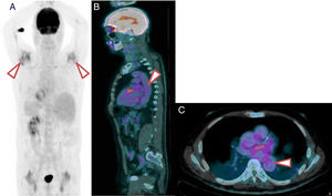18 F-FDG PET/TC de un paciente con PMR y VGV. A) Imagen 18F-FDG PET/TC que muestra inflamación importante en los hombros. B) Corte sagital. Nótese la actividad metabólica de grado 2 de distribución lineal en aorta. C) Corte axial. Nótese la actividad metabólica de grado 2 de distribución lineal en la aorta torácica.