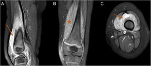 Imagen de la RM de la rodilla izquierda, secuencias STIR con contraste intravenoso (CIV). A) Corte sagital. B) Corte coronal. C) Corte transversal. Se observa importante sinovitis que afecta a la bolsa suprarrotuliana (flechas) e hiperintensidad muscular de vasto interno y externo compatible con piomiositis (estrella).