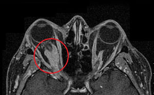 Imagen de la RM con pseudotumor.