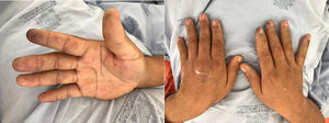 Lesiones isquémicas en pulpejos de las manos, secundarias a vasculitis crioglobulinémica.