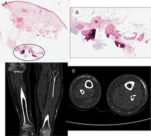 Biopsia. A) Panorámica que muestra epidermis atrófica, telangiectasias en dermis, con área de osificación en dermis profunda y grasa (círculo) (hematoxilina-eosina 4 X). B) Esta área, a mayor detalle, en dermis profunda y tejido celular subcutáneo: trabéculas óseas englobando tejido adiposo (hematoxilina-eosina 40 X). C y D) TAC sin contraste: placas lineales de densidad ósea, de aspecto trabecular/reticular en el tejido celular subcutáneo a lo largo del perímetro de ambas piernas, más evidente en la izquierda, fundamentalmente de la cara externa. Se observa ateromatosis arterial y asimetría en el tamaño de las piernas debido a antigua hemiplejia derecha.