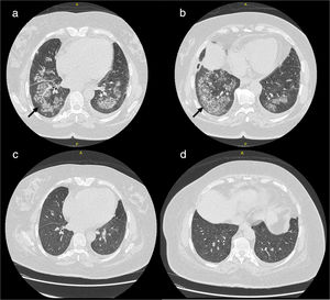 (a, b) Extensive bilateral pulmonary patchy fluffy infiltrates are seen with air alveologram seen within the lower lung lobes are mostly involved; (c, d) complete resolution of lung infiltrates after one month of treatment.