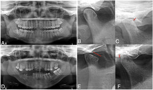 Trastorno radiográfico temporomandibular en pacientes con artritis reumatoide. La ortopantomografía reveló mayor prevalencia de TTM en pacientes con AR (C, D, E, F) en comparación con los individuos del grupo sin AR (A, B), incluyendo mayor prevalencia de erosiones óseas (C), deformidad del cóndilo (E) y disminución del espacio articular (F).
