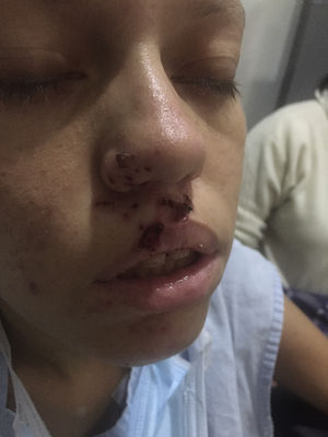 Ptosis palpebral en el momento de la valoración inicial de la paciente y lesiones herpéticas.