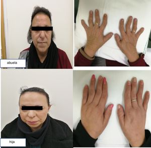 Cabello escaso y nariz bulbosa.