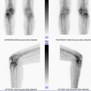 Imagen gammagráfica de la rodilla derecha de una paciente mujer de 47 años con artritis reumatoide a la que se realiza sinoviortesis radioisotópica con Ytrio-90.