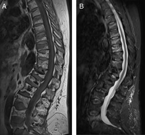 RM del caso 9 realizada tras 9 meses de la suspensión de denosumab, en secuencias T1 (A) y STIR (B).