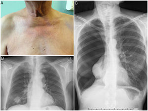 Pacientes con dolor de hombro agudo y ecografía normal. A) Aspecto de las regiones supraclaviculares del paciente varón de 78 años, en el que se aprecia clara simetría del triángulo supraclavicular derecho respecto del izquierdo. B) Radiografía de tórax del mismo paciente en la que se observa una masa pulmonar posteriormente filiada como un carcinoma epidermoide. C) Radiografía de tórax posteroanterior de una mujer de 50 años con dolor agudo de hombro, en la que se aprecia un neumotórax completo del hemitórax derecho sin desviación mediastínica.
