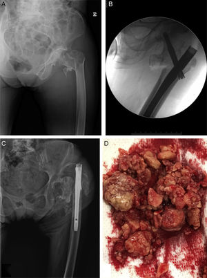 A. Radiografía simple de cadera izquierda, proyección anteroposterior, que muestra fractura pertrocantérea. B. Fluoroscopia intraoperatoria, proyección anteroposterior, que muestra enclavado endomedular de fémur proximal. C. Radiografía simple de cadera izquierda, proyección anteroposterior, que muestra fallo de enclavado endomedular con luxación de cabeza femoral. D. Aspecto macroscópico de los nódulos de osteocondromatosis enviados a anatomía patológica.