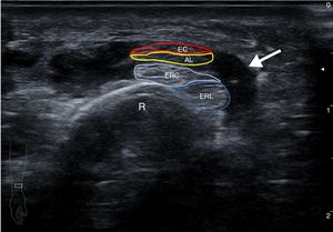 Imagen ecográfica transversal de la región distal de antebrazo derecho. Se observa tenosinovitis (flecha) de los tendones del I y II compartimento extensor a nivel del cruce de ambos. AL: tendón abductor largo del primer dedo; EC: tendón extensor corto del primer dedo; ERC: tendón extensor radial corto; ERL: tendón extensor radial largo; R: radio.