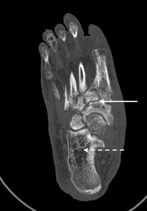 Tomografía computarizada del pie derecho: flecha blanca recta: afectación difusa con desestructuración y remodelación ósea del mesopié tarso-metatarsiana y escafo-cuneiformes. Flecha blanca punteada: áreas radiolúcidas compatibles con osteopenia por desuso.