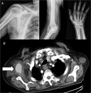 A) Radiografía de hombro, codo y mano derechas, sin luxaciones ni fracturas. El cuerpo lineal corresponde al sistema de infusión de analgesia. B) Angio-TC torácica con seudoaneurisma de arteria axilar derecha de 4,1×2,8×3,3cm (AP×TC×CC) y hematoma perilesional.