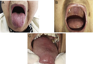 Manifestaciones orales en síndrome de Sjögren. Panel A: boca seca. Panel B: Candida en paladar. Panel C: Candida en lengua.