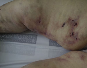 Imagen clínica de las lesiones cutáneas.