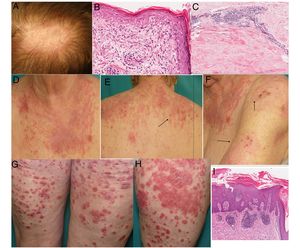 A) Placa eritematosa alopécica en cuero cabelludo con descamación. B) Biopsia de la placa del cuero cabelludo: hiperqueratosis ortoqueratósica, engrosamiento de la membrana basal, degeneración vacuolar y queratinocitos apoptóticos (hematoxilina-eosina×400). C) Biopsia de la induración cutánea lumbar mostrando marcado engrosamiento del septo, hialinización de haces de colágeno e infiltrado linfoplasmocitario perivascular compatible con morfea. Ausencia de paniculitis lobulillar, necrosis hialina de la grasa, focos de calcificación y folículos linfoides descartando paniculitis lúpica (hematoxilina-eosina×200). D-F) Placas eritematoedematosas en áreas fotoexpuestas con áreas erosivas y necróticas (flechas): LECSA. G y H) Placas eritematoescamosas en muslos: psoriasis en placas. I) Biopsia de una placa: hiperqueratosis, paraqueratosis, microabscesos de Munro, adelgazamiento suprapapilar y elongación de capilares dérmicos, típica de psoriasis (hematoxilina-eosina×200).