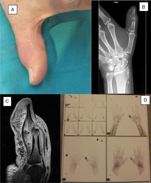 A) Tumefacción y eritema de la articulación interfalángica del primer dedo. B) Radiografía simple. C) Secuencia sagital del primer dedo potenciado en T2 en la RMN. D) Gammagrafía marcada con galio 67.