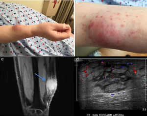 (a) Enlarged soft tissue tumor in the right forearm with small papules, (b) detailed view of the same lesion (c) (a) MRI T1 FS coronal view, showing enhancing lesion without a discrete mass in the right forearm with edema, ulceration along the superficial fascia as well as along the subcutaneous fat with skin thickening (blue arrow). (d) Ultrasonography of the dorsal forearm showing increased soft tissues with thickening of the fat pad and enlarged septa, with slight power Doppler signal in peripheral areas.